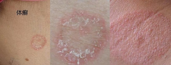 乳痂和湿疹的区别图片图片